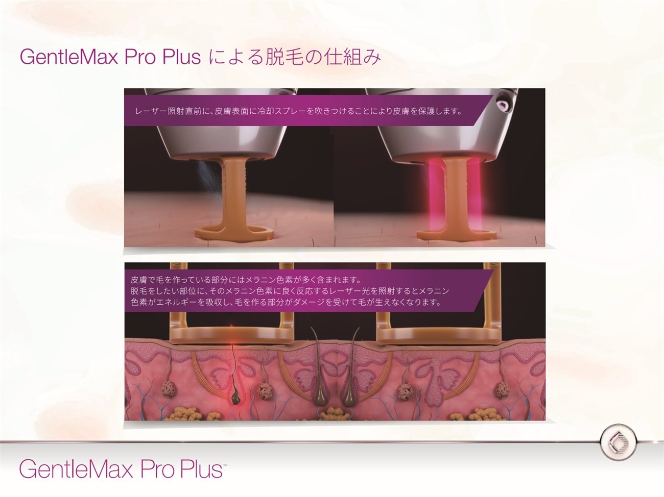 GentleMax Pro Plus による脱毛の仕組みの図。照射直前に皮膚表面へ冷却スプレーを噴きつけ、メラニン色素を含む毛にレーザーが反応してエネルギーを吸収する様子